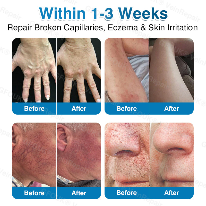 🇨🇦🏆✅️🏃Glownrst® VeinRepair Microneedle Patch Roll⚡Instant Relief, Long-Term Results