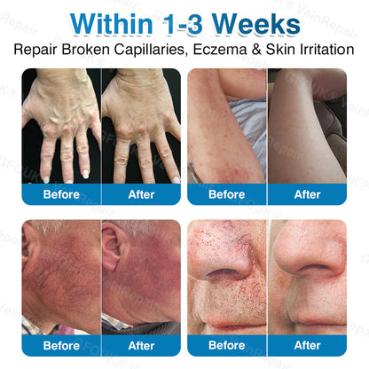 🇨🇦🏆✅️🏃Glownrst® VeinRepair Microneedle Patch Roll⚡Instant Relief, Long-Term Results