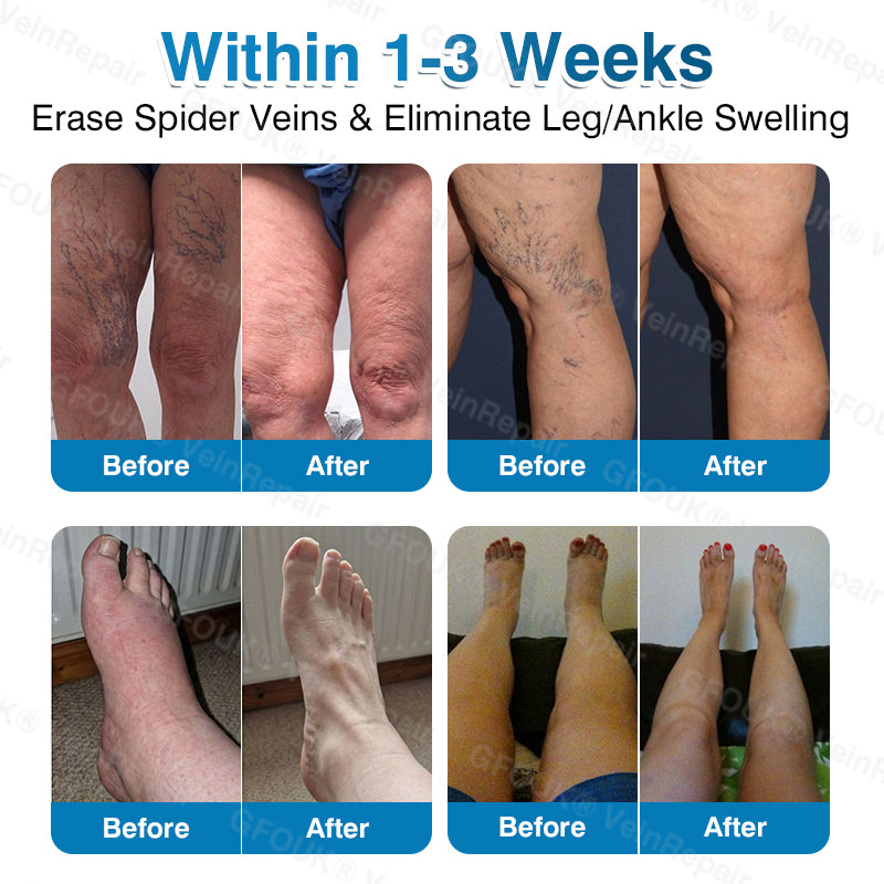 🇨🇦🏆✅️🏃Glownrst® VeinRepair Microneedle Patch Roll⚡Instant Relief, Long-Term Results