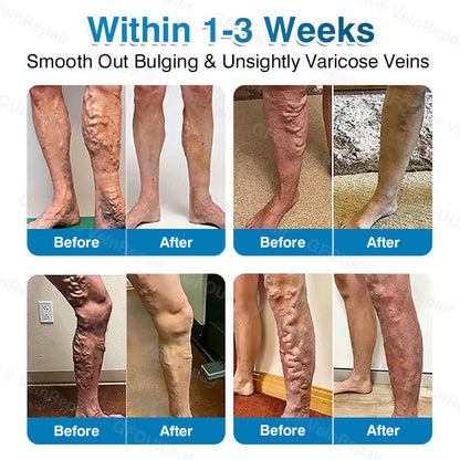 🇨🇦🏆✅️🏃Glownrst® VeinRepair Microneedle Patch Roll⚡Instant Relief, Long-Term Results
